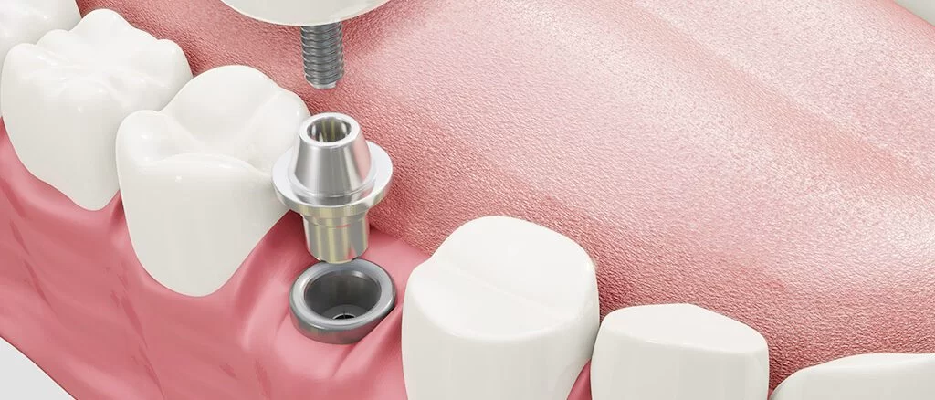 implant-cover-1024x438